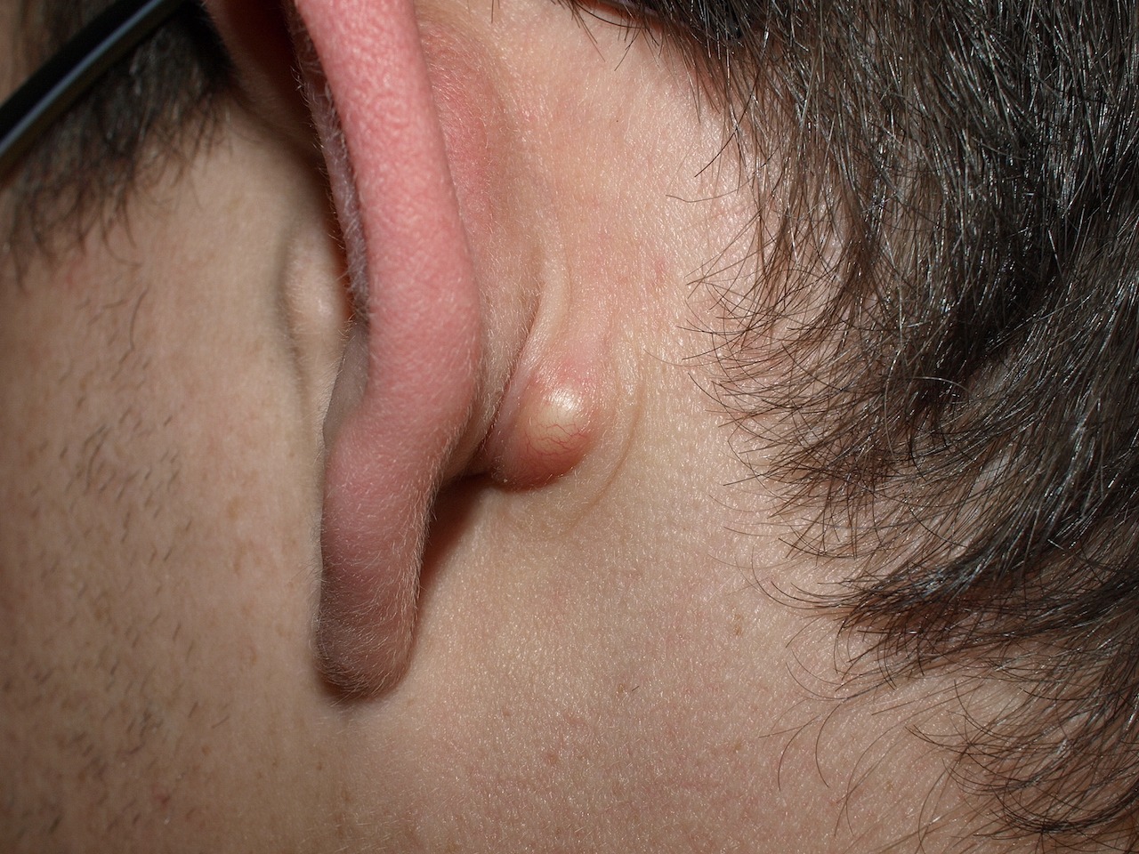 du lobe de l'oreille causes et traitement
